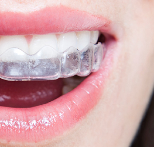 Invisalign Köln